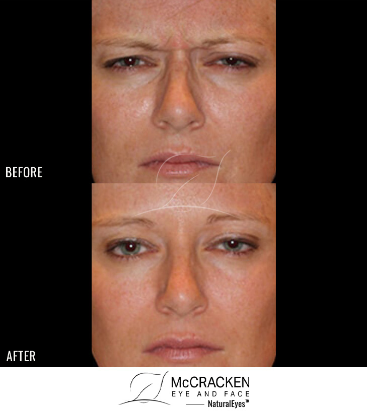 36 Year Old Female – Neurotoxin to Frown Lines, Forehead and Crow’s Feet