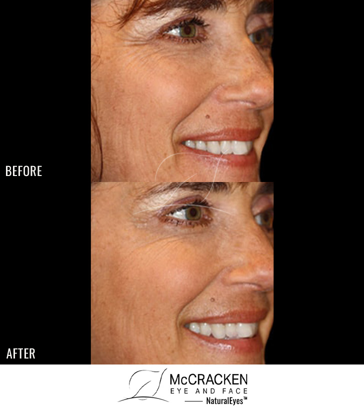 52 Year Old Female – Neurotoxin® to Crow’s Feet
