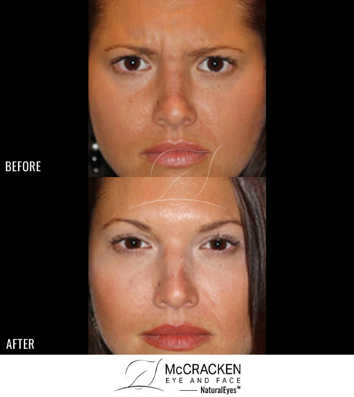 28 Year Old Female – Neurotoxin to frown lines and forehead