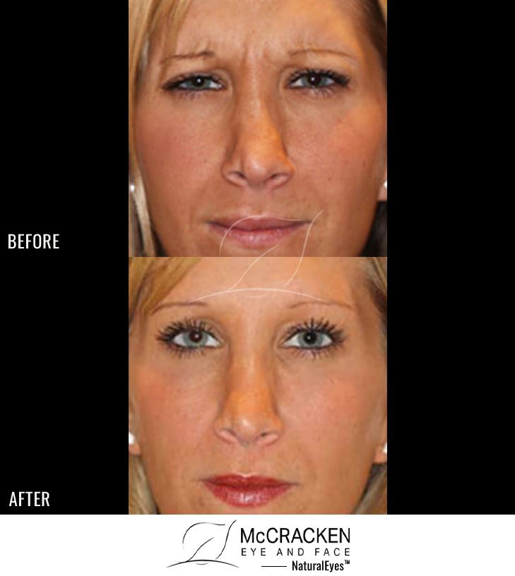 31 Year Old Female – Neurotoxin® to Frown Lines and forehead