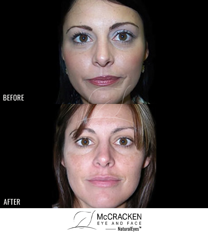 30 Year Old Female – Neurotoxin, Right Brow Lift (Forehead Lift)