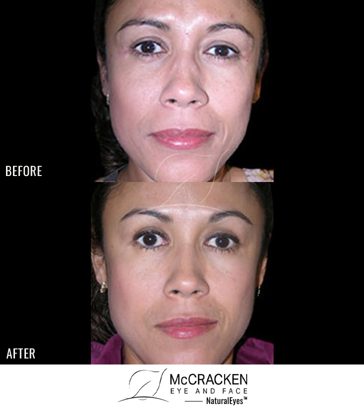 41 Year Old Female – Neurotoxin injected in frown lines