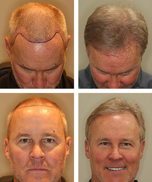  Before and After Picture 
54 Year Old Male, 18 months after 1509 grafts
