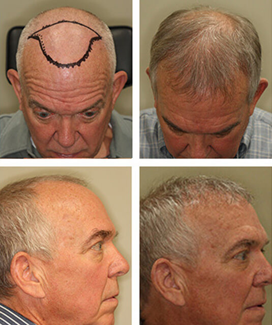  Before and After Picture 
60 Year Old Male, 10 months after 1951 grafts
