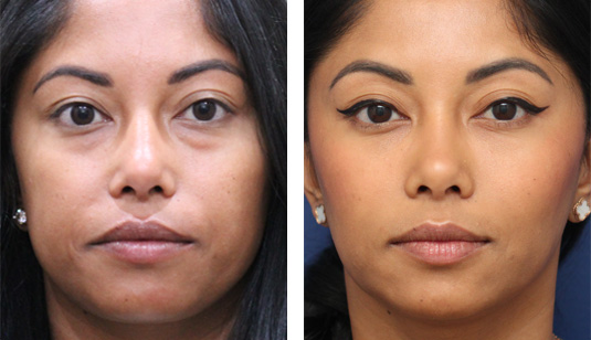  Before and After Picture 
35 Year Old Female –Neurotoxin to Masseter Muscles to Slim Jawline