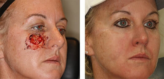  Before and After Picture 
44 year old female - Repair of right cheek defect after skin cancer excision