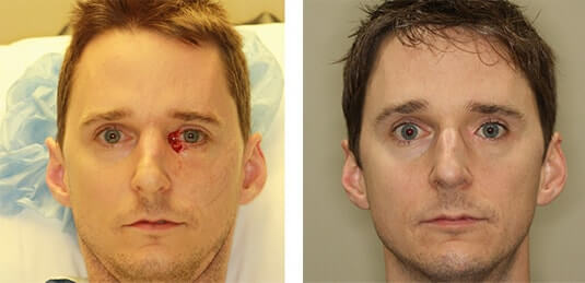  Before and After Picture 
36 year old male - Repair of left medial canthal defect after skin cancer excision