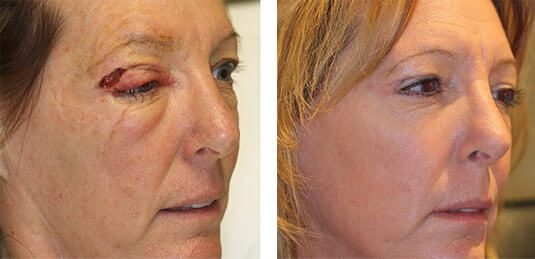  Before and After Picture 
50 Year old female - Repair of right upper lid defect after skin cancer excision