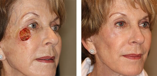  Before and After Picture 
75 year old female - Repair of right cheek defect after skin cancer excision