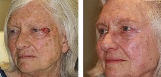  Before and After Picture 
72 year old female -Repair of left lateral canthal defect after skin cancer excision