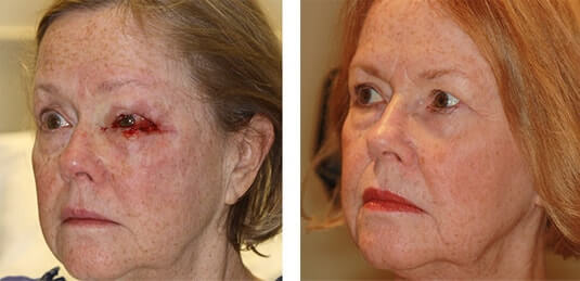  Before and After Picture 
65 year old female - Repair of left upper and lower lid defect after skin cancer excision