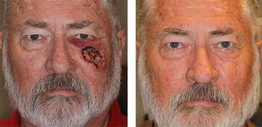  Before and After Picture 
74 year old male - Repair of left cheek defect after skin cancer excision