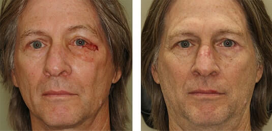  Before and After Picture 
59 year old male - Repair of left lower lid and lateral canthal defect after skin cancer excision