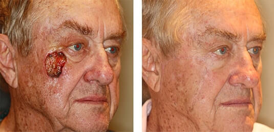  Before and After Picture 
80 year old male - Repair of right cheek defect defect after skin cancer excision
