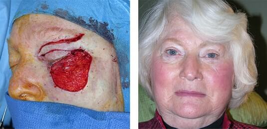  Before and After Picture 
71 year old female - Repair of left lower lid defect after skin cancer excision