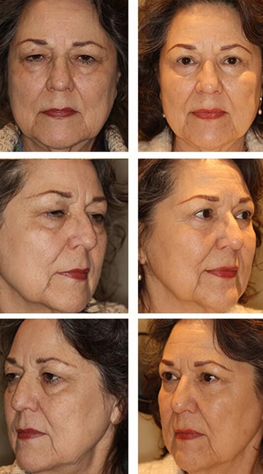  Before and After Picture 
68 Year Old Female - Upper and Lower Blepharoplasty with Periocular Laser Skin Resurfacing