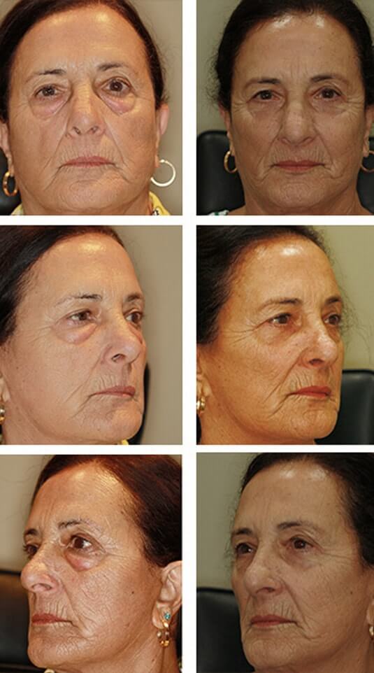  Before and After Picture 
68 Year Old Female - Right Upper Lid Ptosis Repair and Bilateral Lower Blepharoplasty