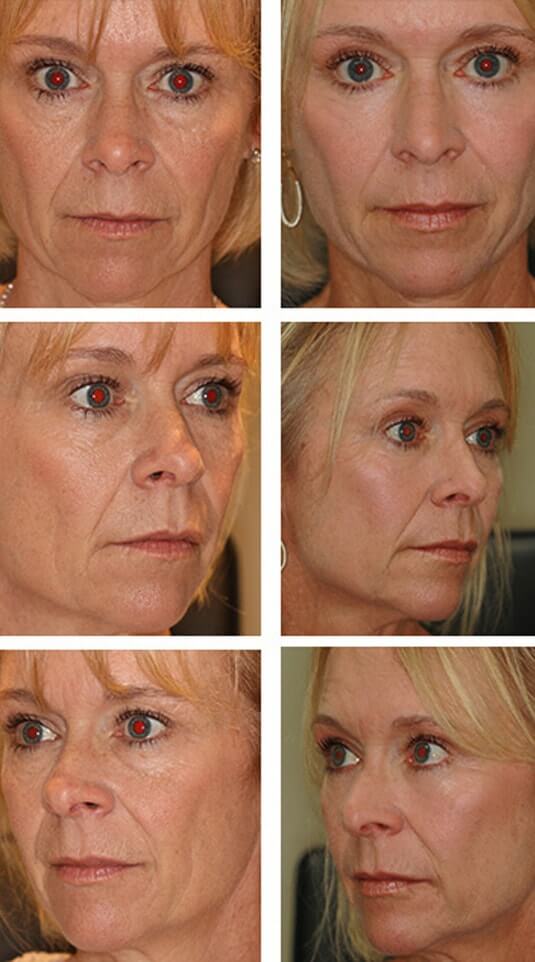  Before and After Picture 
54 year old female - Bilateral Lower Blepharoplasty with Periocular Laser Skin Resurfacing