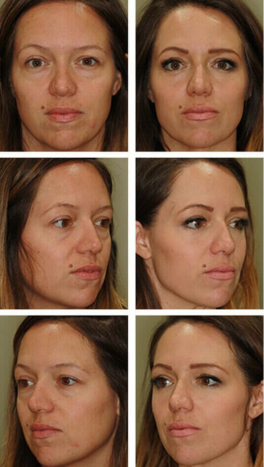 Before and After Picture 
36 Year Old Female – Lower Blepharoplasty with Periocular Laser Skin Resurfacing