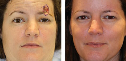  Before and After Picture 
38 year old female - Repair of left brow defect after skin cancer excision