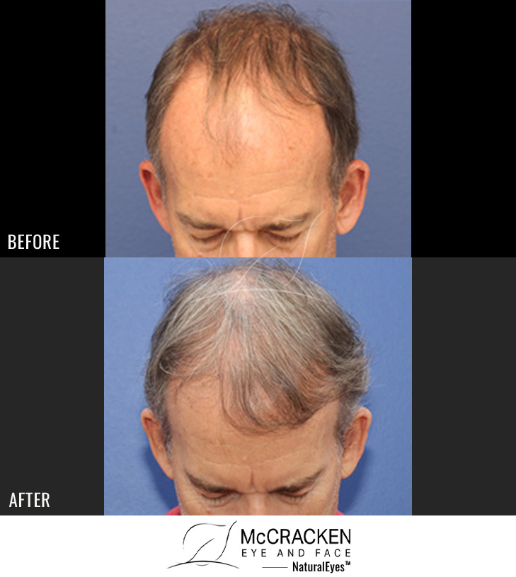 63 year old male, 1 year after FUE transplant; 2816 grafts to the hairline and crown.