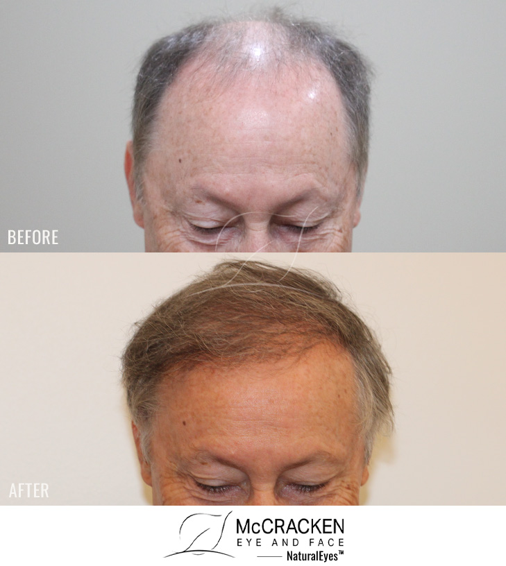67 year old patient, 1 year after 2500 grafts to the hairline.