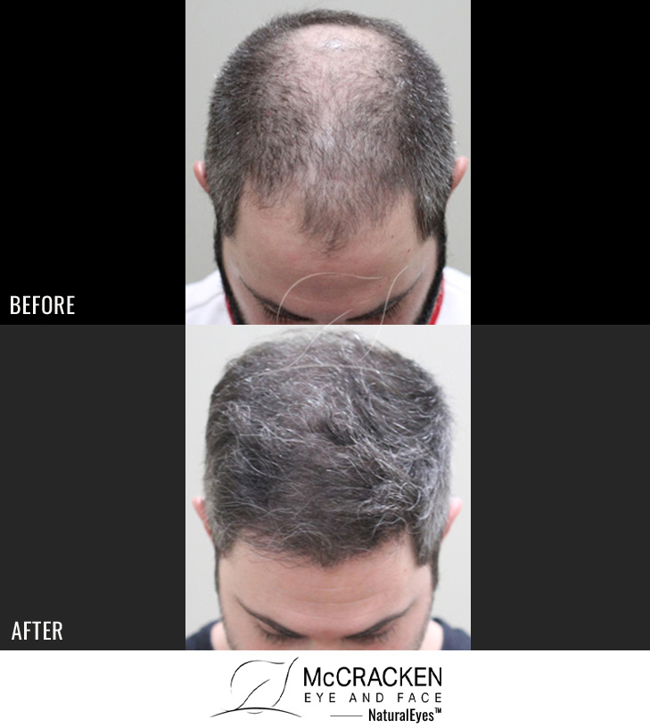 31 year old male, 7 months after 3000 grafts to the hairline and crown.