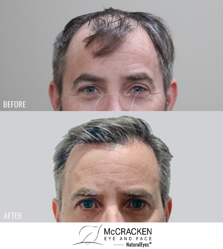 49 year old male, 1 year after 2522 grafts to the hairline and crown.