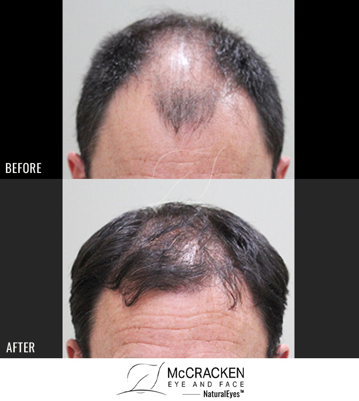 49 year old male,1 year after 2678 grafts to the hairline and top of the scalp.
