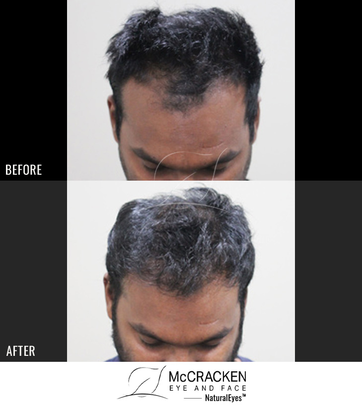 30 year old male,1 year after 2013 grafts to the hairline and crown.