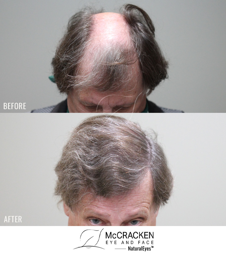 70 year old male, 1 year after 2895 grafts.