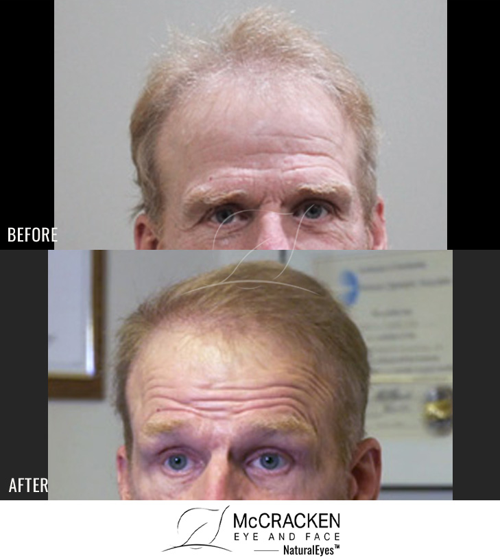 62 Year Old Male, 2 1/2 years after 1517 grafts