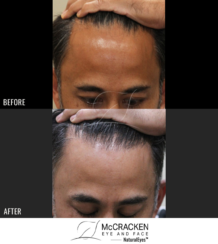 44 Year Old Male, 1 Year After 2020 Grafts to Hairline