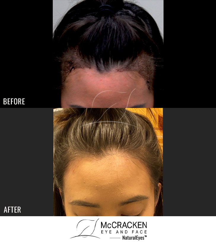 26 Year Old Female, 1 day s/p and 6 Months s/p 650 Grafts to the Hairline
