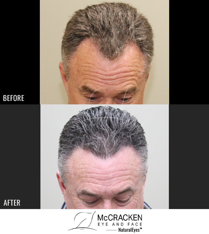 55 Year Old Male, 6 Months s/p 1400 Grafts to the Hairline