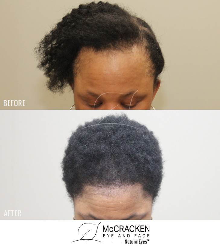 49 year old female, 6 months s/p 1500 grafts to her hairline to treat traction alopecia.