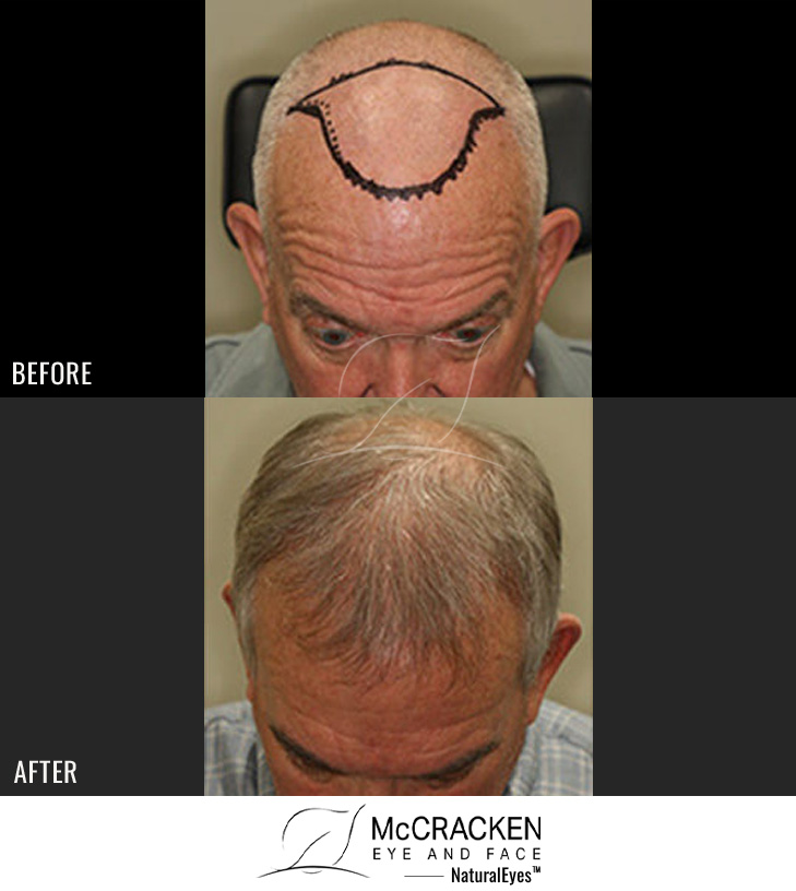 60 Year Old Male, 10 months after 1951 grafts