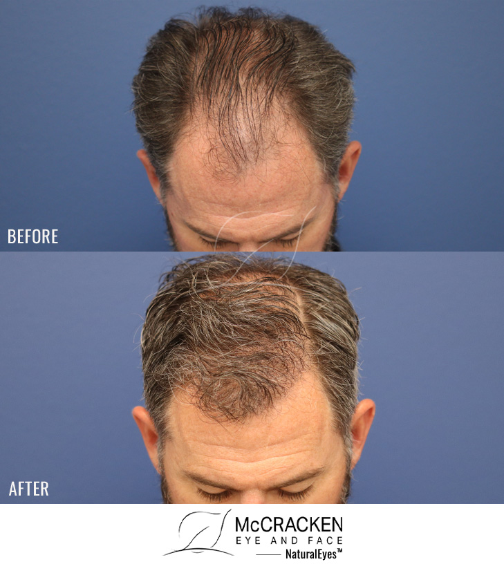 47 year old male, 1 year after FUE transplant; 3000 grafts to the hairline and midscalp.