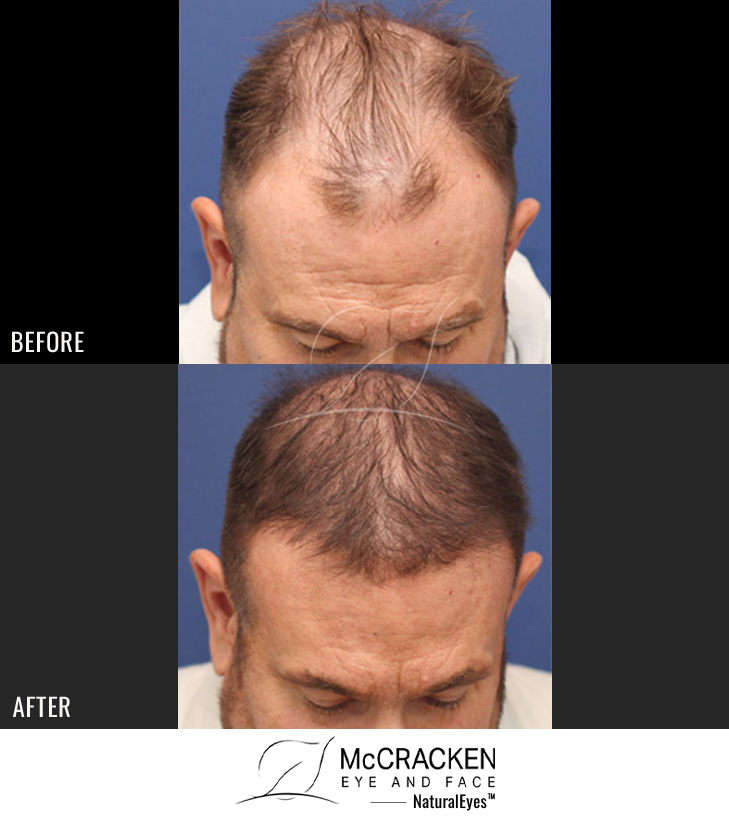55 year old male, 7 months after 2701 grafts to the hairline and top of the scalp.