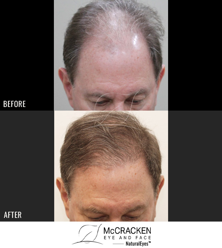 67 year old male, 1 year after 2500 grafts to the hairline.