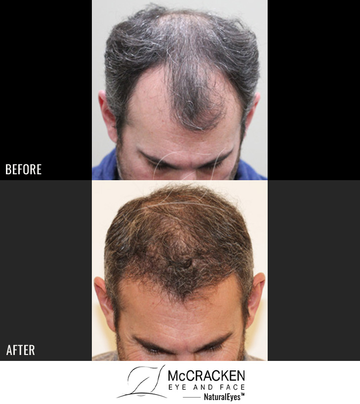 44 year old male, 1 year after 2000 grafts to the hairline and crown.