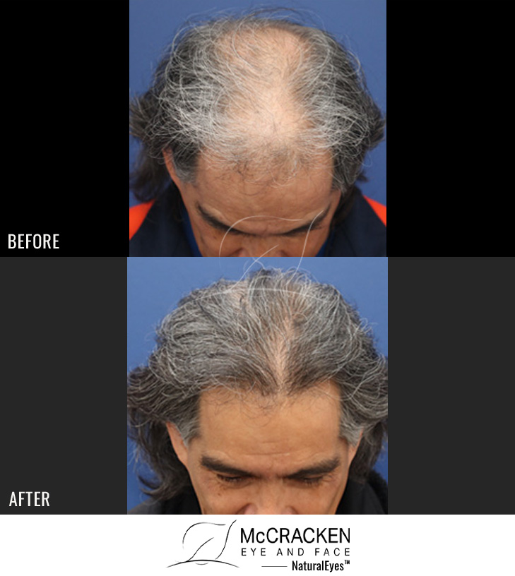 58 year old male, 1 year after FUE transplant; 2500 grafts to the hairline and midscalp.
