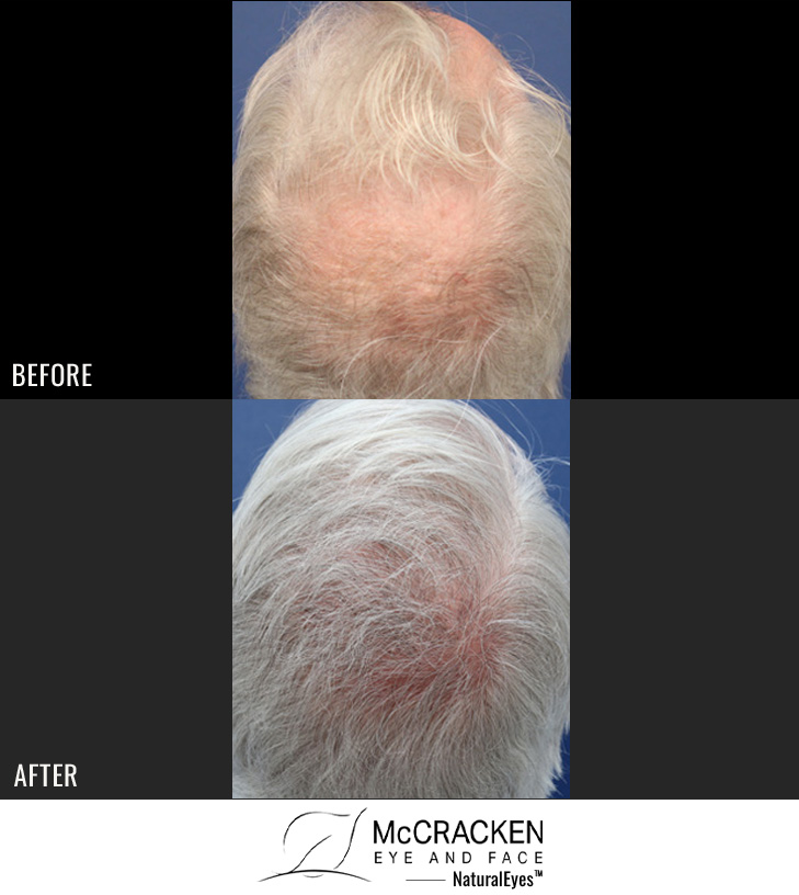 54 year old male, 1 year after FUE transplant; 2414 grafts to the crown.
