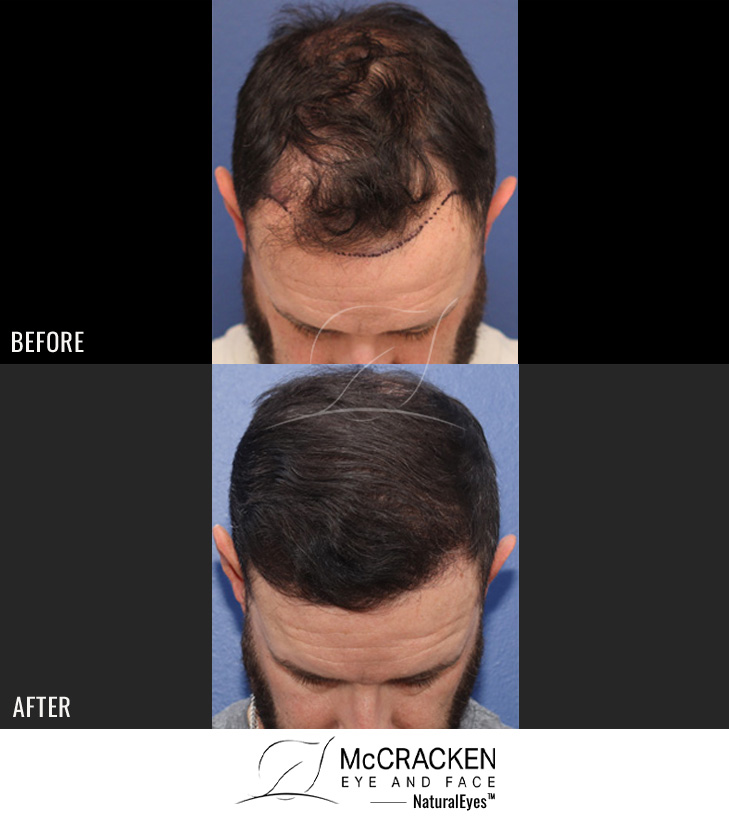 40 year old male, 1 year after FUE transplant; 2500 grafts to the hairline and crown.