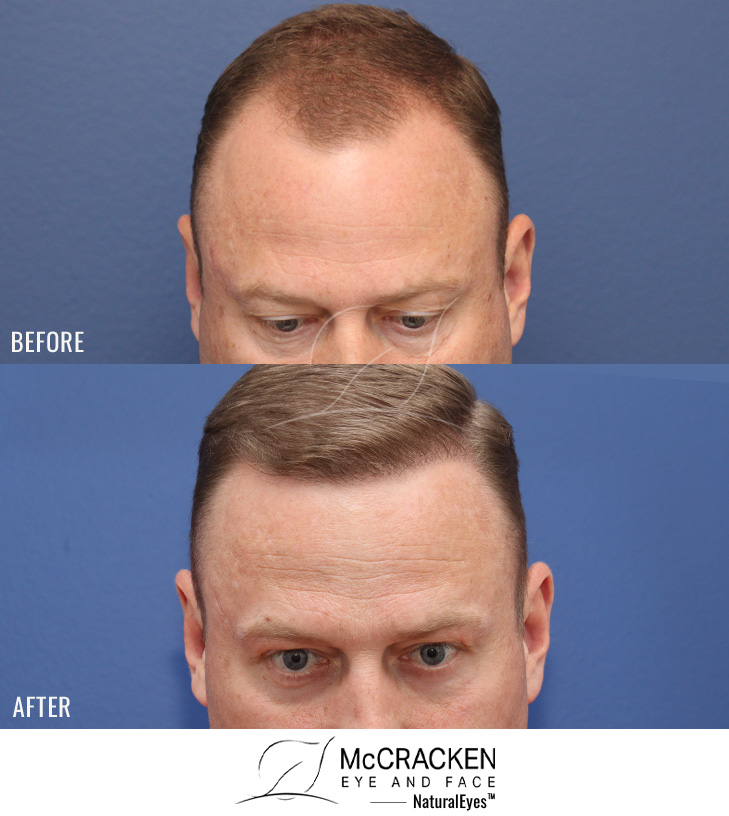 49yo male 1y s/p 2500 grafts to hairline.