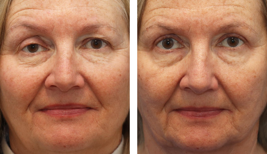 Before and After Picture
61 year old female – Right Upper Eyelid Ptosis (Droopy Eyelids) Repair with Bilateral Upper Eyelid Ptosis Repair. Before and After Picture
61 year old female – Right Upper Eyelid Ptosis (Droopy Eyelids) Repair with Bilateral Upper Eyelid Ptosis Repair.