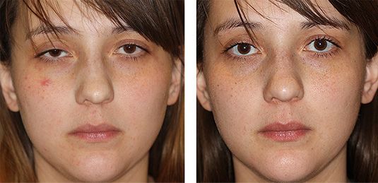  Before and After Picture  
22 year old female - Right Upper Eyelid Ptosis (Droopy Eyelids) Repair