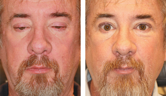  Before and After Picture 
60 year old male– Bilateral Upper Eyelid Ptosis (Droopy Eyelids) Repair
