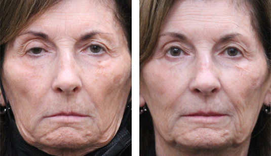  Before and After Picture 
76 year old female – Bilateral Upper Eyelid Ptosis (Droopy Eyelids) Repair