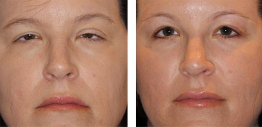  Before and After Picture  
39 year old female - Bilateral Upper Eyelid Ptosis (Droopy Eyelids) Repair
